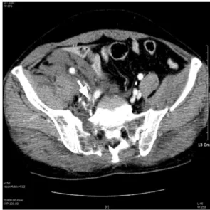 Fig. 1. A 67 year old man was sustained pelvic bone  fracture. Enhanced abdominal CT showed extravasation of  contrast in right internal iliac artery injury (arrow)