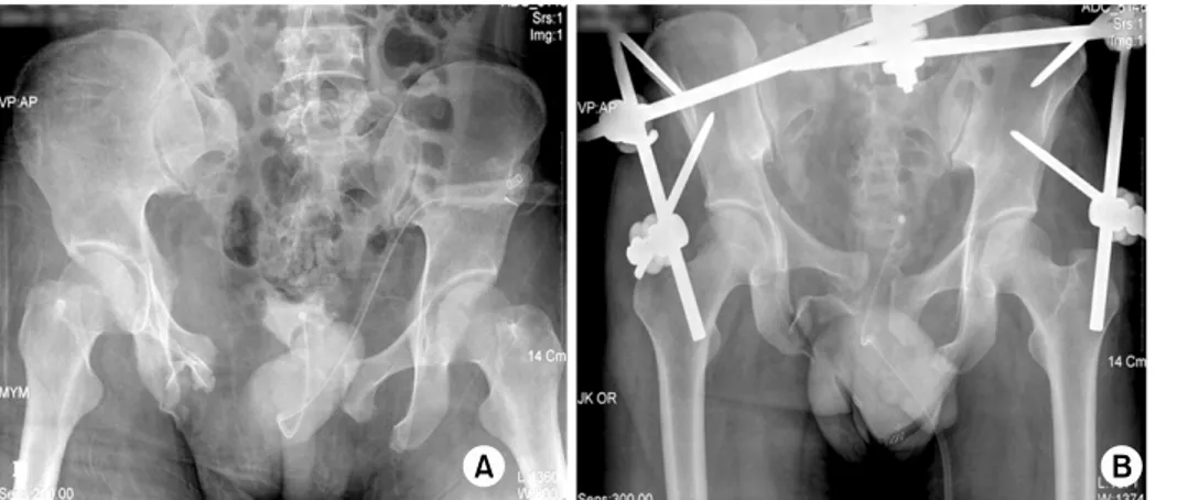Fig. 3. AP radiograph of the  pelvis before (A) and after  (B) application of external  fixator.