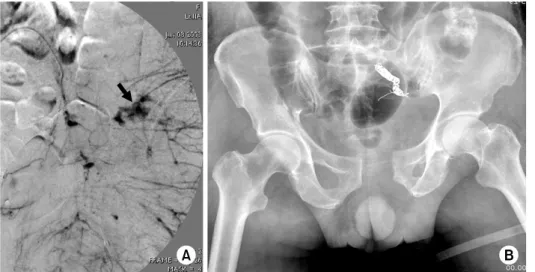 Fig. 4. Fluoroscopic images  (A)  showing extravasation of  contrast (arrow) in a internal  iliac artery injury, which is  the controlled with  angio-graphic coiling (B)