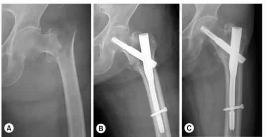 Table 3. Immediately postoperative reduction status 