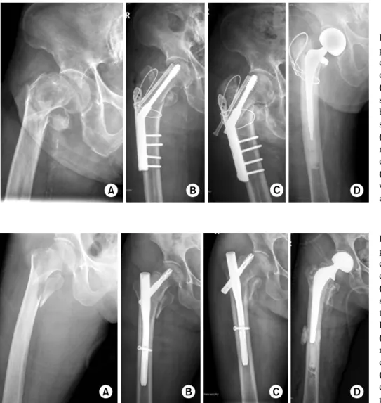 Fig. 5. (A) 84 year old female patient presented with  intertro-chanteric fracture as AO/ASIF classification A2.2