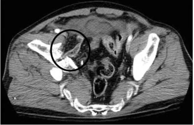 Fig. 3. Initial axial image of pelvis CT shows entrapped  bowel between fragments of acetabulum (circle).