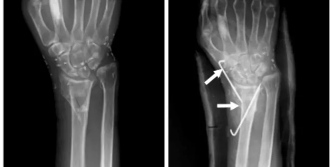 Fig. 1. K-wire fixation for the treatment of osteoporotic  distal radius fracture. Increased risk of reduction loss and wire  migration