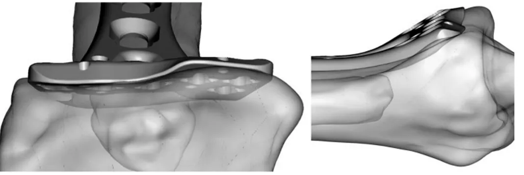 Fig. 3. Advanced design of a  locking plate shows low  pro-file and meets well with the  anatomy of the distal radius.
