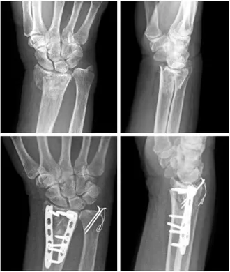 Fig. 11. 2.0 mm small locking plate provides sufficient  stability for the comminuted distal ulna fracture.