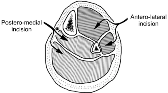 Fig. 2. Double incision technique to decompress the  compartment syndrome.    마비는  비교적  나중에  나타나는  징후로서  동통은  근육의 직접적인  손상,  동반된  신경  상등과  혼동이  될  수  있다