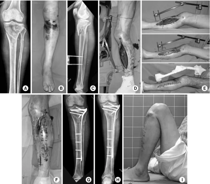 Fig. 3. The patient with a proximal tibia fracture (A) showed a severe swelling around the knee (B)