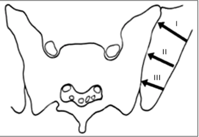 Fig. 1. Classification of crescent fracture according to Day et  al. The positions of the principal fracture lines are shown  for crescent fracture-dislocation types I, II and III, as defined  by axial CT sections, reformatted parallel to the sacroiliac  s