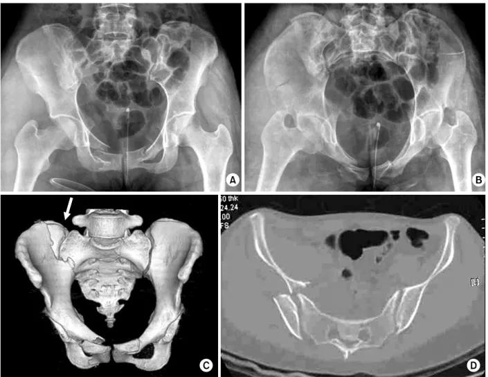 Fig. 2. (Patient 2) (A, B) A  19-year-old woman had a lateral compression injury of the pelvic ring from the right side