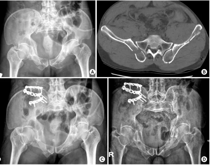 Fig. 4. (Patient 14) (A, B) A 49-year-old man had a Type II of crescent fracture-dislocation