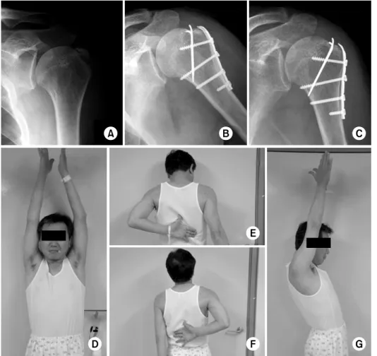 Fig. 2. A 49-years-old male  sustained a isolated greater  tu-berosity fracture of the  proxi-mal humerus by a fall on the  ground.