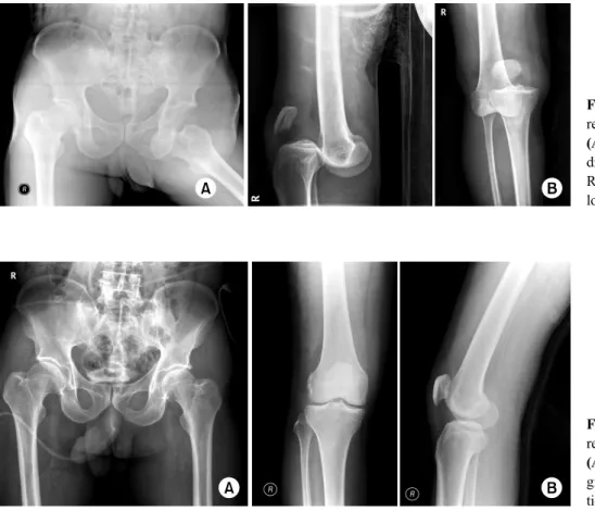 Fig. 2. Radiographs show post-  reduction state. 