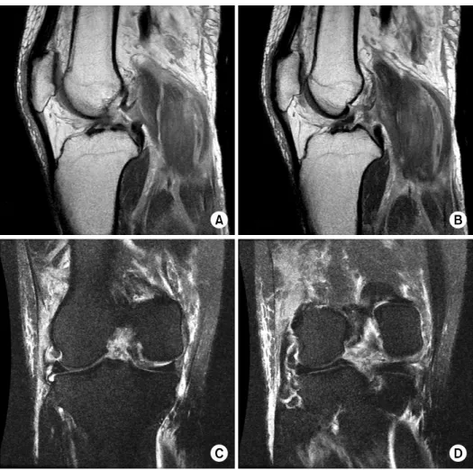 Fig. 3. (A, B) MRI findings  indicate the ruptures of the  ACL and the PCL. 