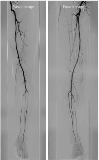 Fig. 4. Peripheral angiography shows no occlusion of blood  flow. Meyers  등 6) 은  파열  인대에  대한  수술적  치료의  결과가  양 호한  것으로  보고하고  있으며  Sisto과  Warren 7) 도  수술적  치료  방법이  비수술적  치료  방법보다  나은  결과를  보인다 고  하였다