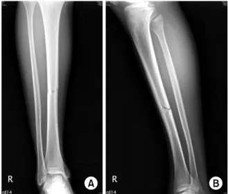 Fig. 2. Initial radiograph of right leg AP (A) and lateral (B) shows right tibia shaft fracture.