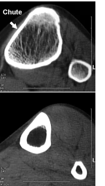 Fig. 2. The CT scan of the  proximal tibia shows triangular shape of the medullary canal  with most narrow medial  tion
