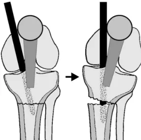 Fig. 3. Medial entry point and laterally directed insertion  angle of the nail into the proximal fragment results in  val-gus malalignment as the nail engages into the distal  frag-ment.