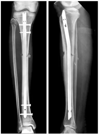 Fig. 5. Lateral radiograph of the proximal tibial fracture  treated with an AO unreamed interlocking nail shows  an-terior displacement of the proximal fragment (posan-terior  dis-placement of the distal fragment) by the wedge effect of the  nail