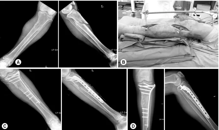 Fig. 6.  (A, B) A 68 year old man with proximal tibial fracture was treated with percutaneous plating using LCP-PLT on the lateral side.