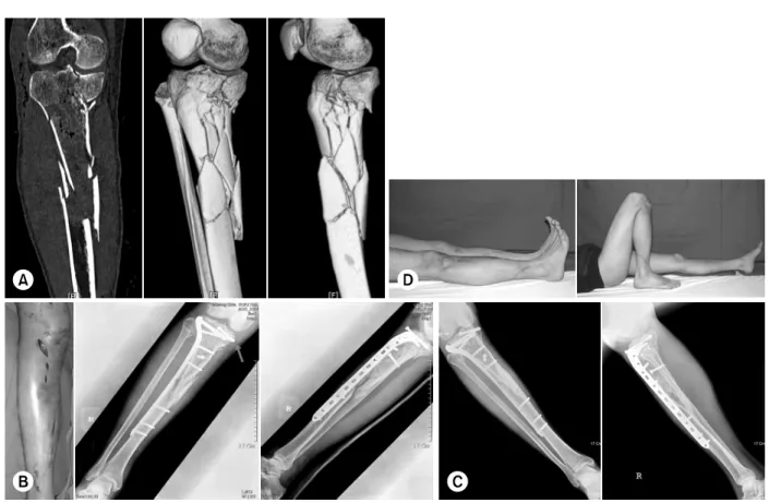 Fig. 7.  (A, B) A 32 year old man with proximal tibial comminuted fracture was treated with percutaneous plating using  LCP-PLT on the lateral side