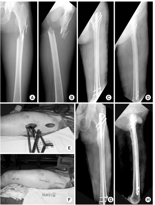 Fig. 1. (A, B) A 43-year-old  male sustained Winquist-Hansen type I, OTA/AO type B1  frac-ture of the left proximal femur.