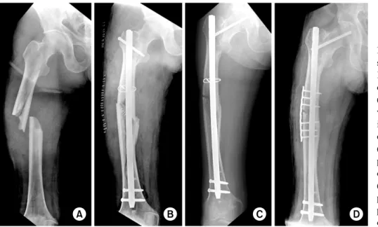 Fig. 2. (A) A 49-year-old male sustained Winquist-Hansen type  IV, OTA/AO type C1 fracture  of the right femur