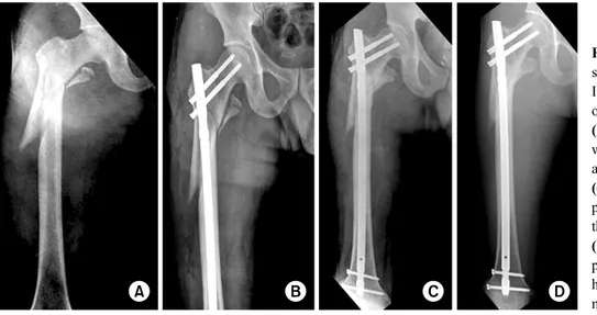 Fig. 3. (A) A 47-year-old male sustained Winquist-Hansen type IV, OTA/AO type C1 fracture  of the right femur