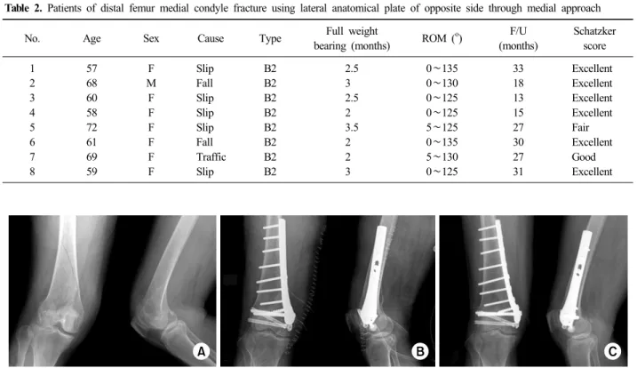 Table 2. Patients of distal femur medial condyle fracture using lateral anatomical plate of opposite side through medial approach