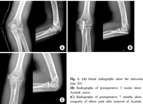 Fig. 1. (A) Initial radiographs show the intra-articular olecranon fracture of  type IIA.