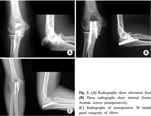 Fig. 3. (A) Initial radiographs  show olecranon fracture of  type IIB.
