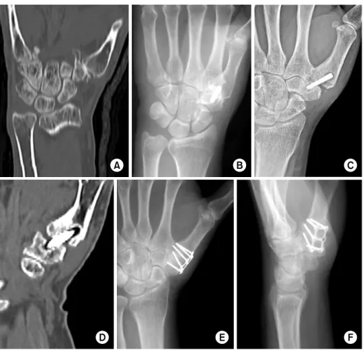 Fig. 3. (A) CT shows fracture  of trapezium and  carpometa-carpal joint degenerative arthritis and osteophyte formation
