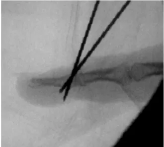 Fig. 4. After removal of a towel clip, a second K-wire is  inserted through the bony fragment to distal phalanx