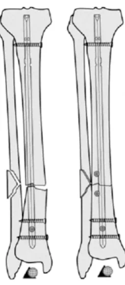 Fig. 1. Correction of angular malalignment using Poller screws.