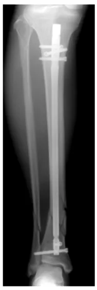 Fig. 7. Parallelism between distal interlocking screws and  tibial distal articular surface is an important tip to avoid  axial malalignment in distal tibial nailing.