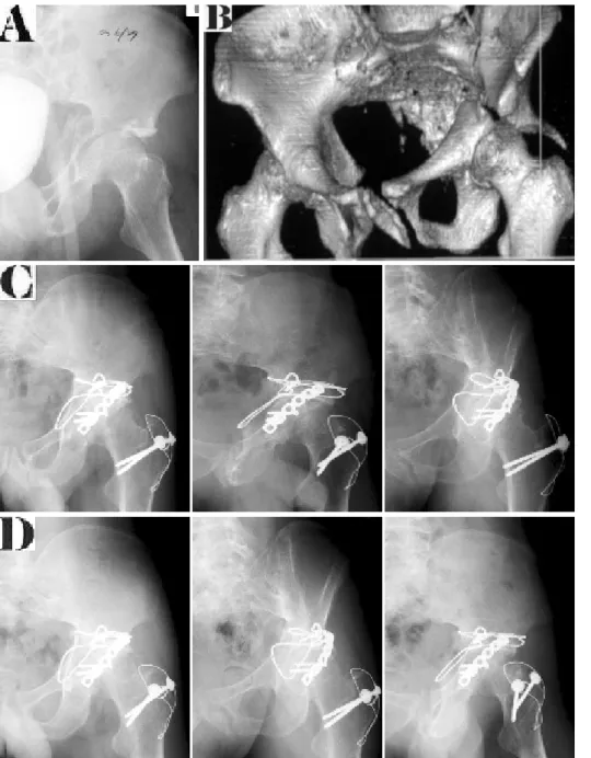 Fig. 1. (A) Initial radiograph  of a 37 years old male  shows transverse and  poste-rior wall fractue