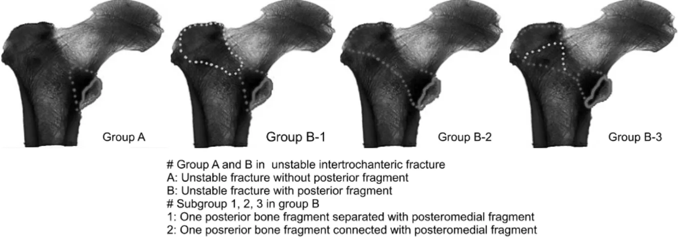 Fig. 1. Modified classification of unstable intertrochanteric fracture.서        론    불안정  대퇴골  전자간부  골절에서  견고한  고정을  얻기  위해  여러  고정  기구들이  사용되어  왔으며,  예전부터  활강  압박  고  나사가  많이  사용되어  오다가  최근에는  짧은  지렛대로 인한  생역학적  안정성과  상대적으로  작은  절개를  장점으로 가진  근위  대퇴  골수  