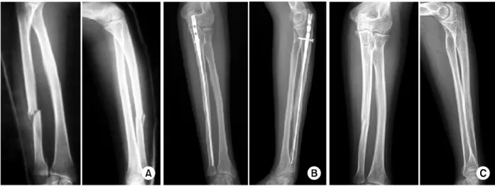 Fig. 3. (A) Radiographof 56-year-old man showing of radius shaft fracture after direct trauma