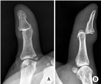Fig. 2. Intraoperative photograph showing extracted palmar  plate from interphalangeal joint (forceps)