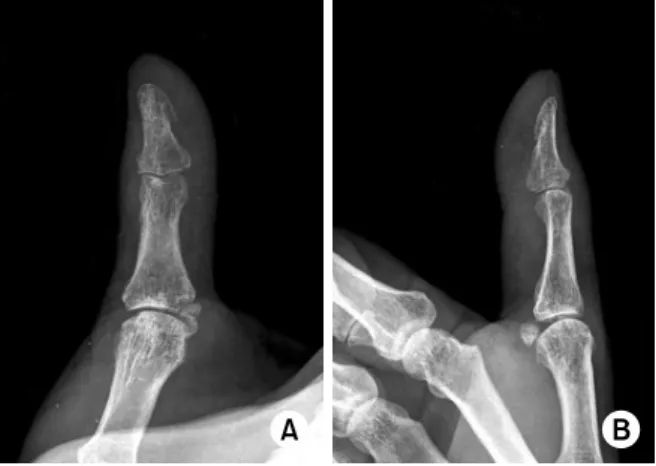 Fig. 4. At postoperative 6 months, the anteroposterior (A)  and lateral (B)  X-ray show good joint space and restoration  of articular congruity.