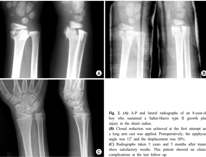 Fig. 2. (A) A-P and lateral radiographs of an 8-year-old  boy who sustained a Salter-Harris type II growth plate  injury in the distal radius