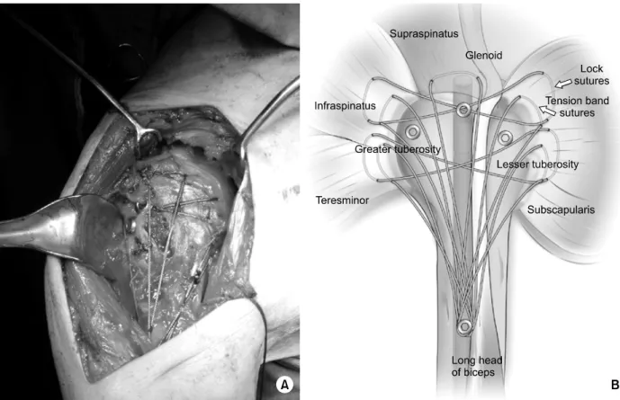 Fig. 2. (A, B) Locking sutures and tension band sutures to increase the stability the humerus using #5 non-absorbable braided  sutures