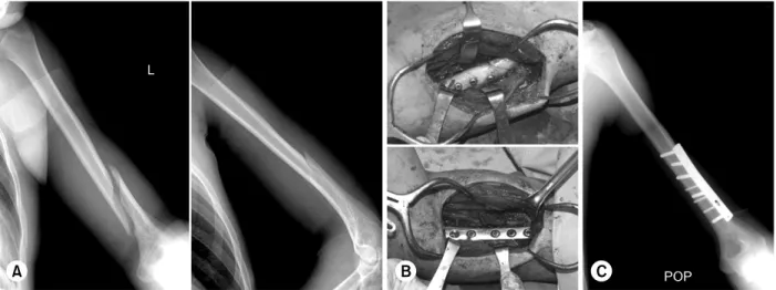 Fig. 3. (A) Radiographs of 17-year-old male show a oblique spiral fracture of the left distal 1/3 humerus with radial nerve  palsy after close reduction