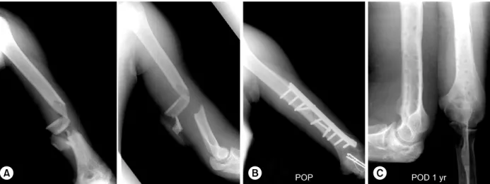 Fig. 4. (A) Radiographs of 21-year-old male show an open comminuted fracture of the left humeral shaft