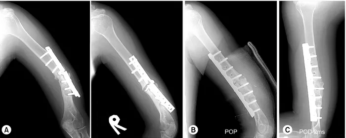 Fig. 5. (A) Radiographs of 62-year-old male show a nonunion with the metal breakage. 