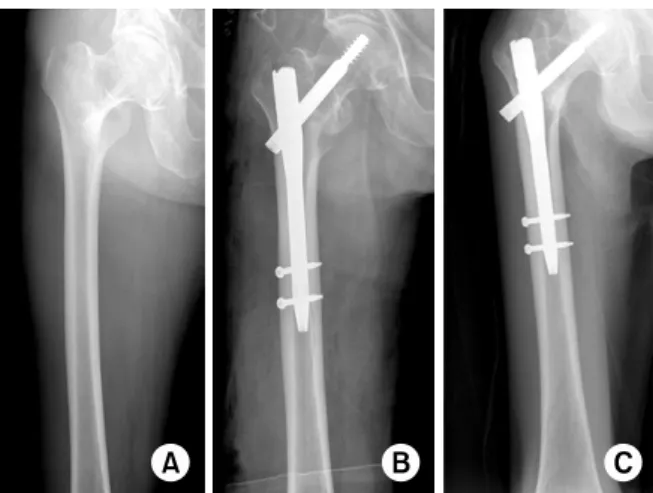 Fig. 2. (A) Rt. femur AP view shows A1 type stable inter- inter-trochanteric fracture (according to OTA/OA classification) of  78 years old male patient
