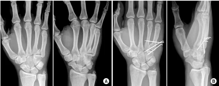 Fig. 1. Type I injury. 
