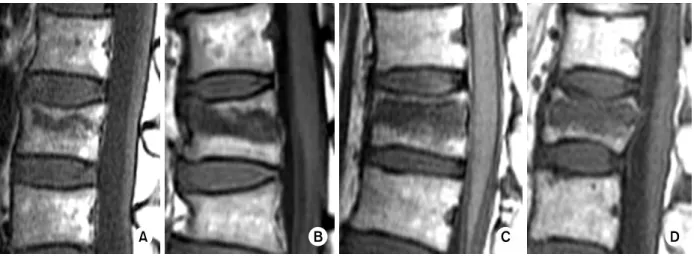 Fig. 1. Size of bone marrow edema on T1-weighted image. 