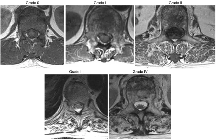 Fig. 2. Classification of paravertebral muscle atropy accoding to Goutallier classification.