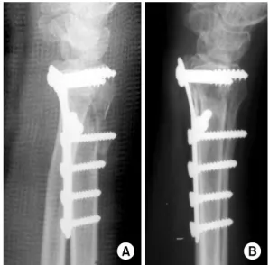 Fig. 2. (A) The distal radius fracture was fixed with  conventional plate, and the volar tilt was acceptable  immediately after operation.