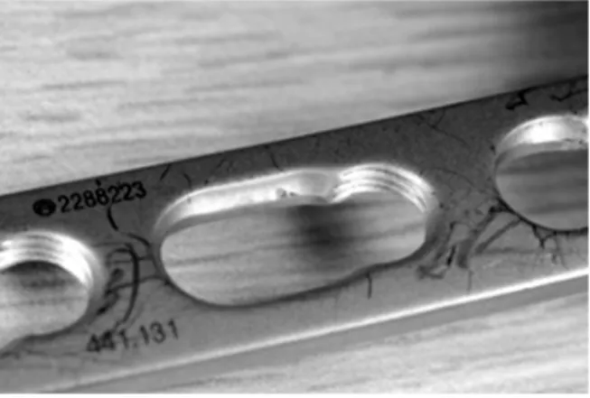 Fig. 4. Volar juxtaarticular locking plate, Synthes Ⓡ . Fig. 5. Combihole, Synthes Ⓡ .된  부분이  원위  요골  골편이  재전위하려는  힘에  버틸  수  있어야  한다